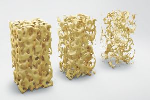 Osteoporose: Neue Leitlinie zur besseren Diagnostik und modernen Therapie