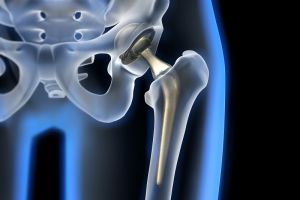 Künstliches Knie- und Hüftgelenk: Wachsamkeit bei Infekten und Verletzungen