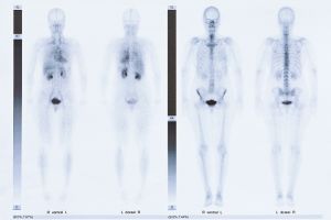 Diagnostik in Orthopädie & Unfallchirurgie: Skelettszintigrafie