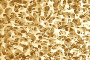 Osteoporose erklärt 