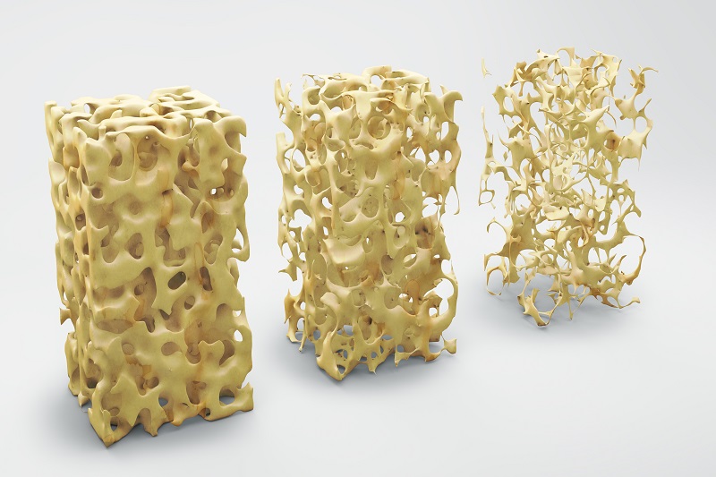 Osteoporose: Neue Leitlinie zur besseren Diagnostik und modernen Therapie